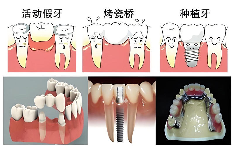 假牙价格及装假牙费用详解